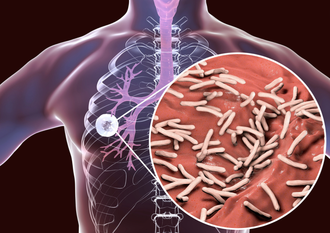 Tuberkulosis Paru: Metode Diagnosis dan Pemeriksaan yang Akurat