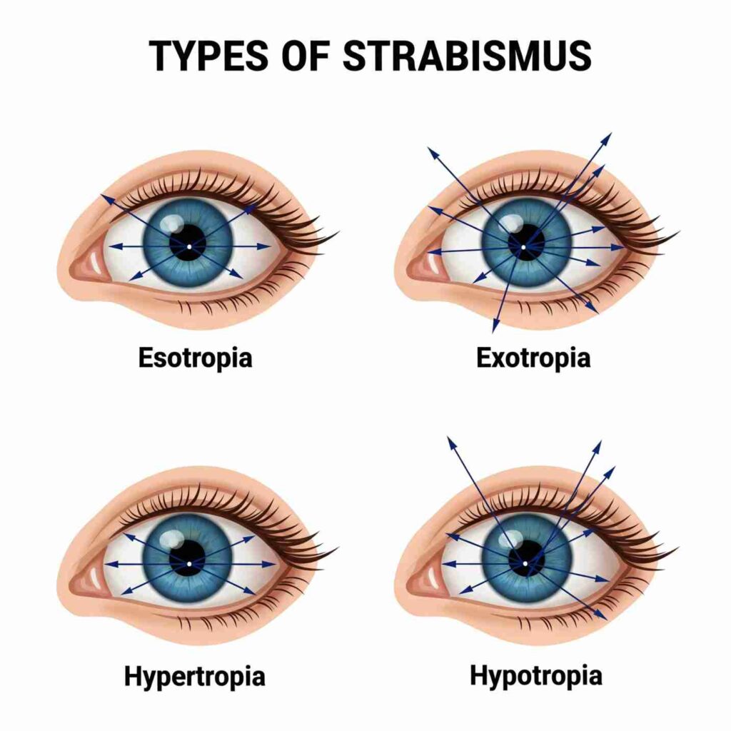 Strabismus