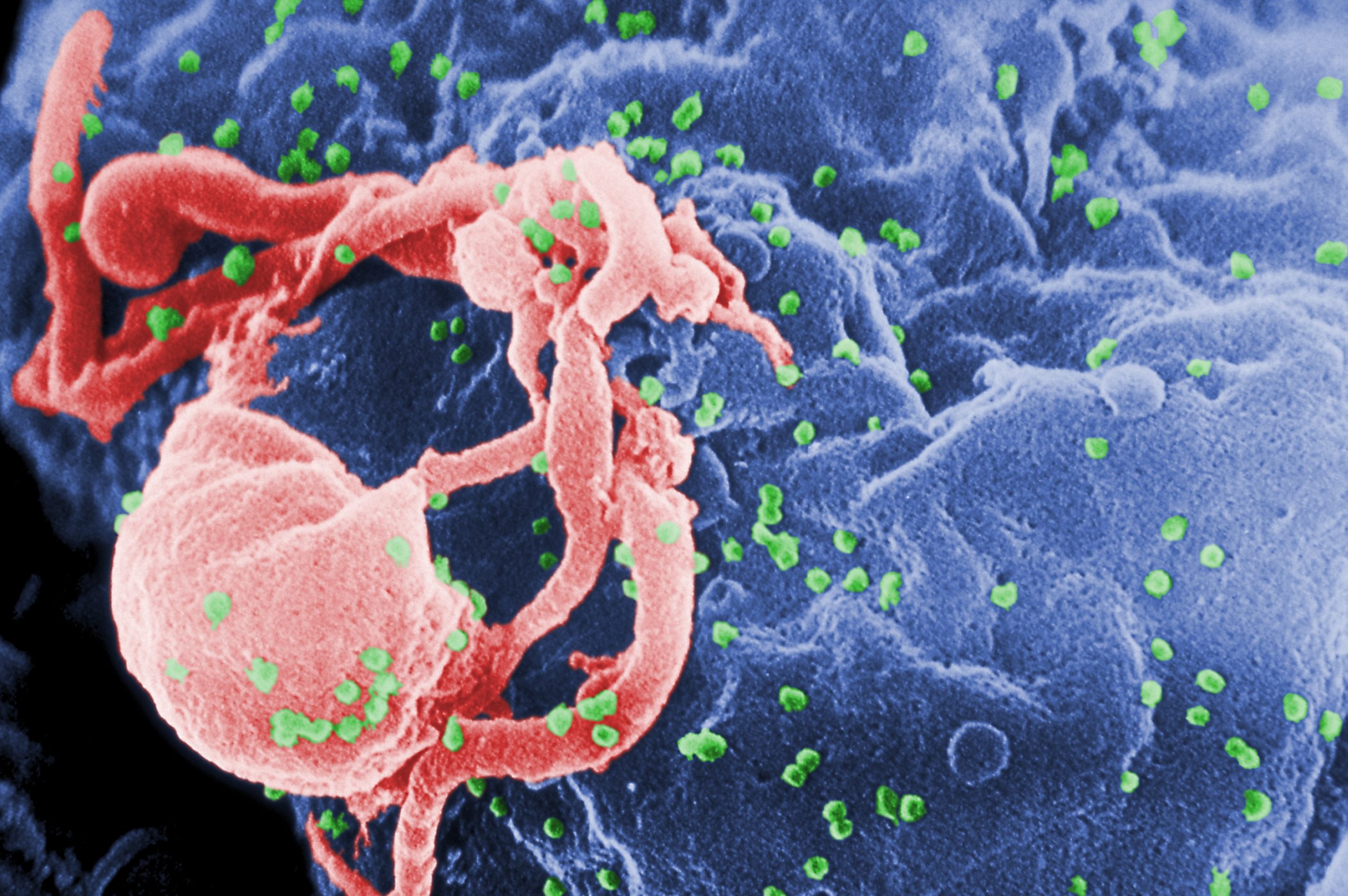 HIV AIDS