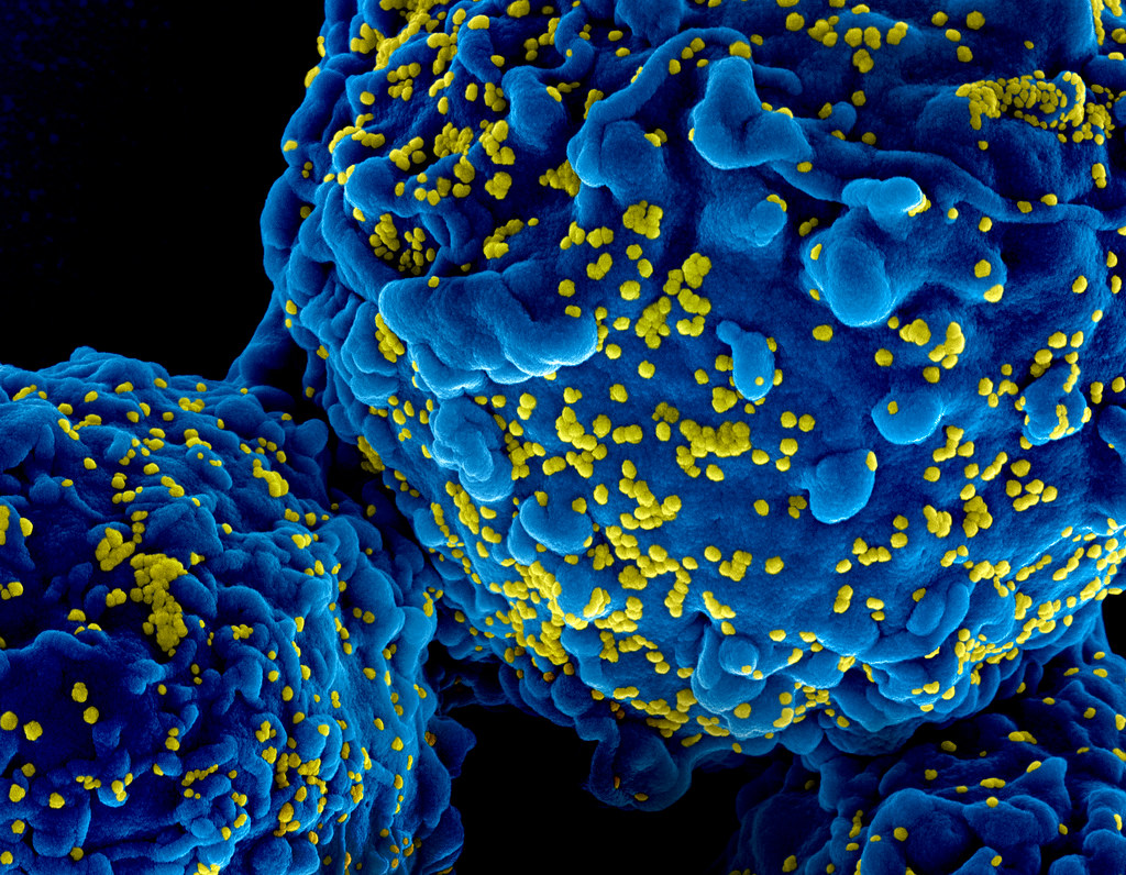 HIV AIDS