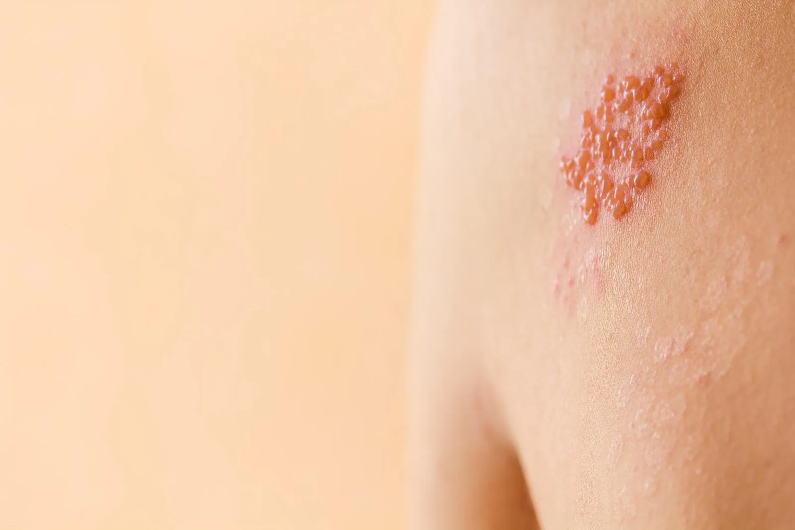 Herpes Zoster