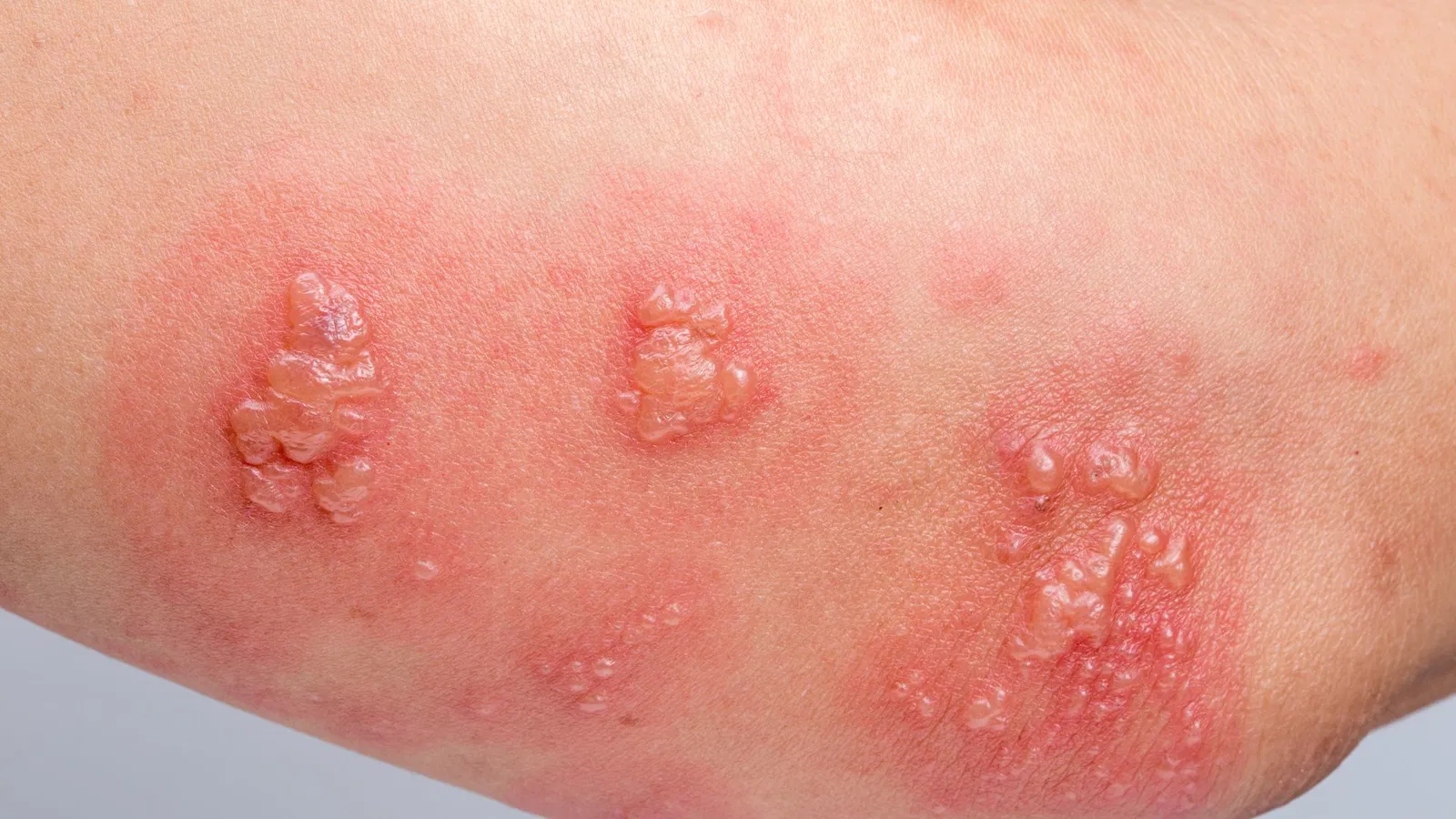 Herpes Zoster