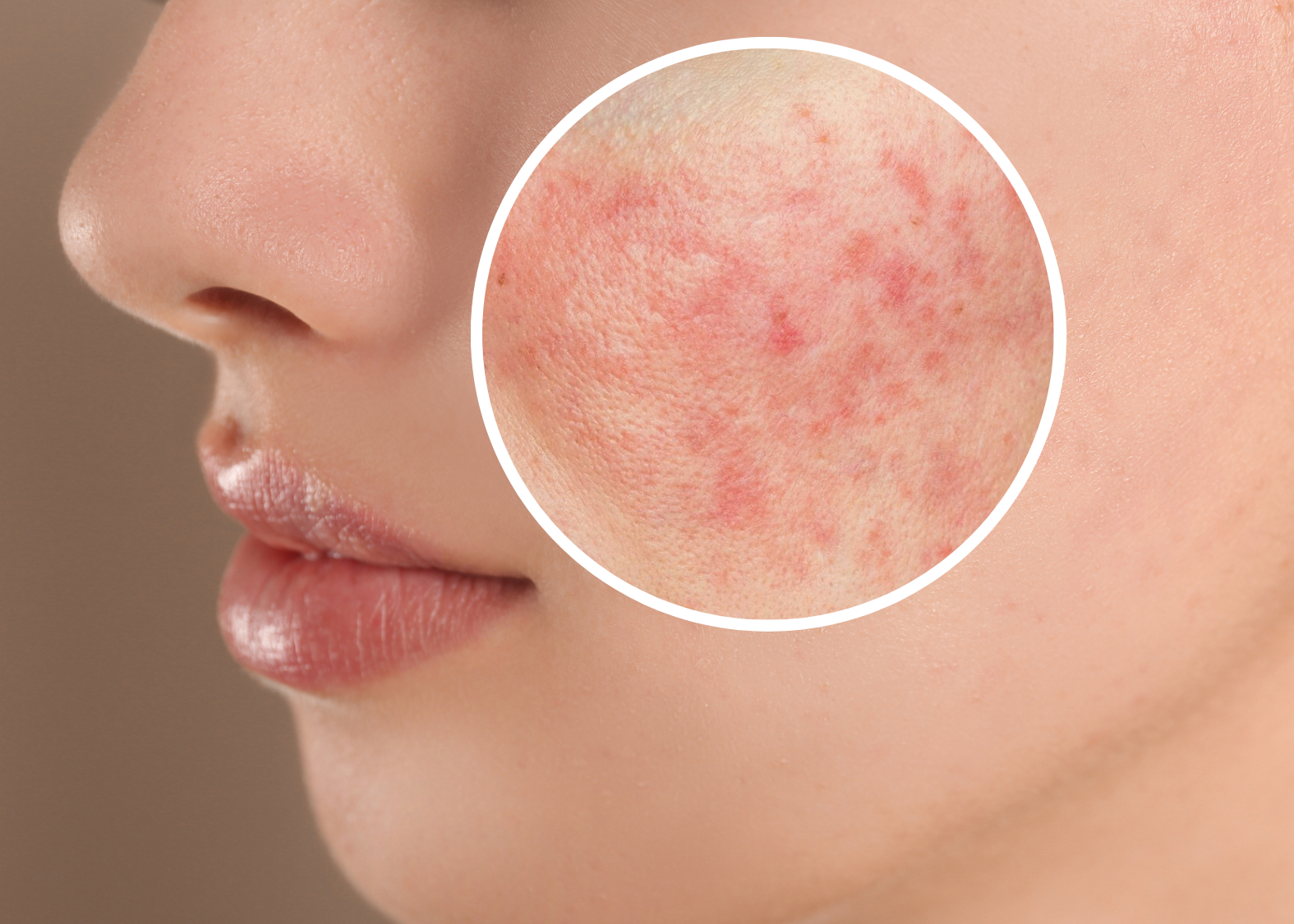 Rosacea