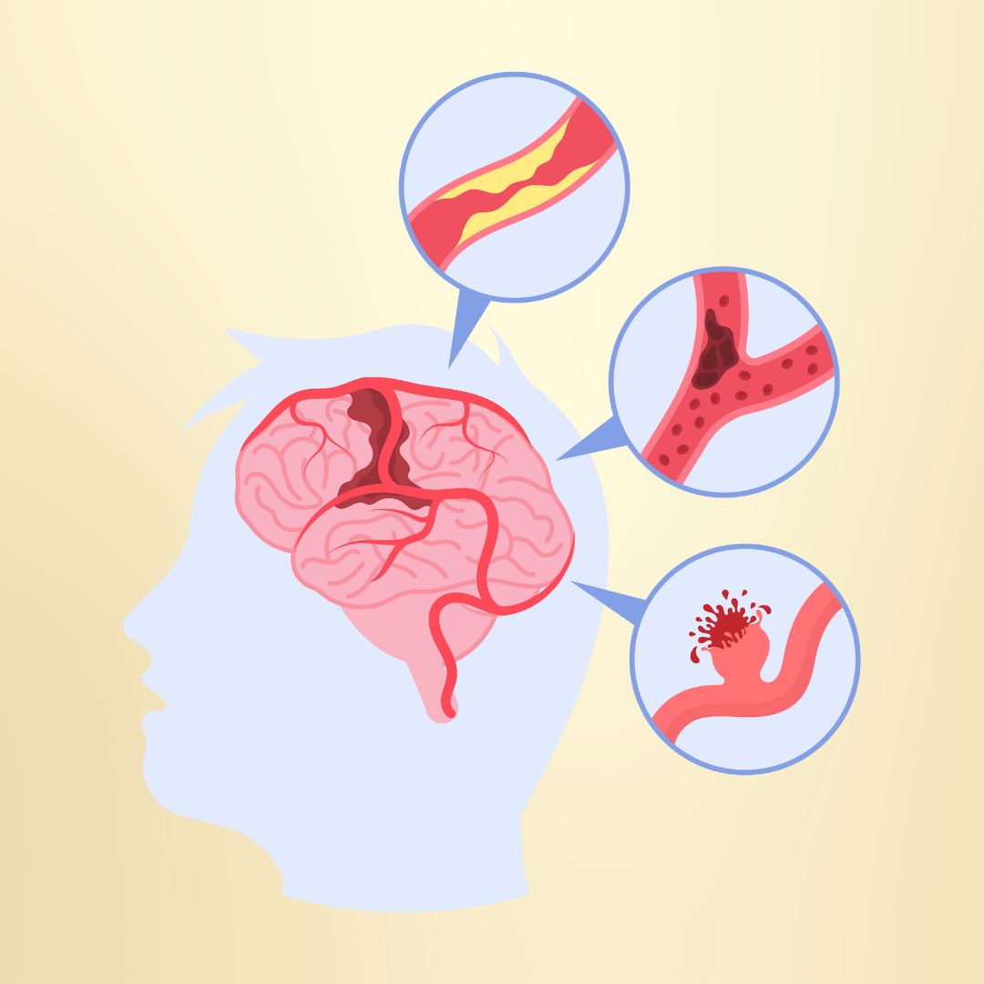 Ischemic Stroke