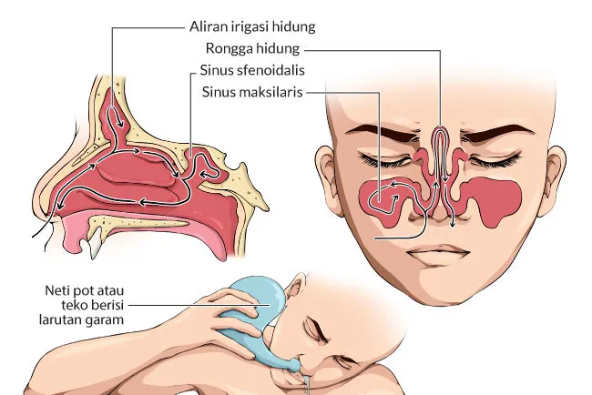 Hidung Sinusitis: Mengenal Penyebab dan Faktor Pemicu yang Harus Dihindari