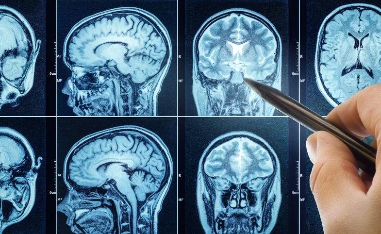 Tumor Otak Jinak: Penyebab dan Faktor Risiko