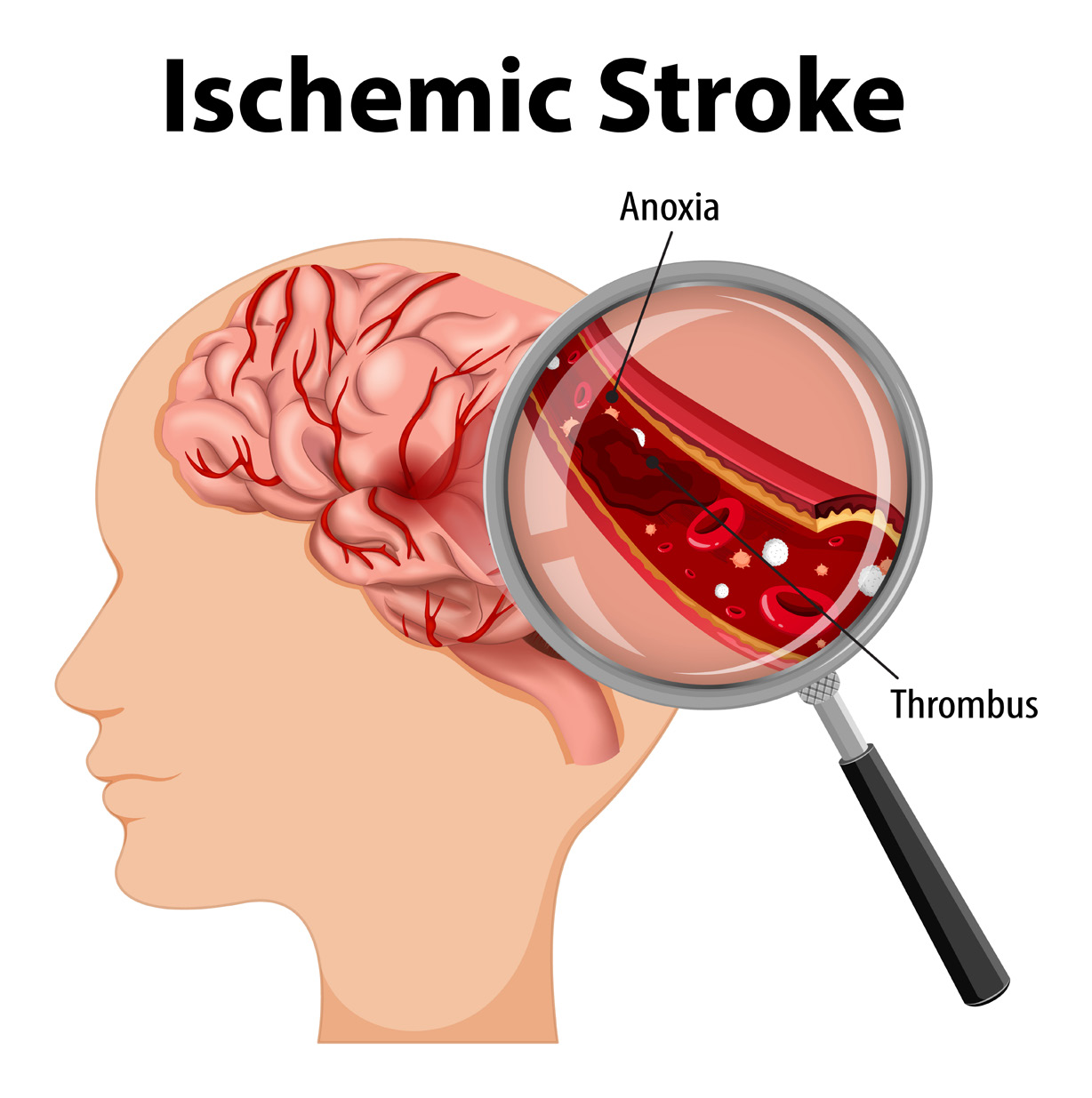 Ischemic Stroke