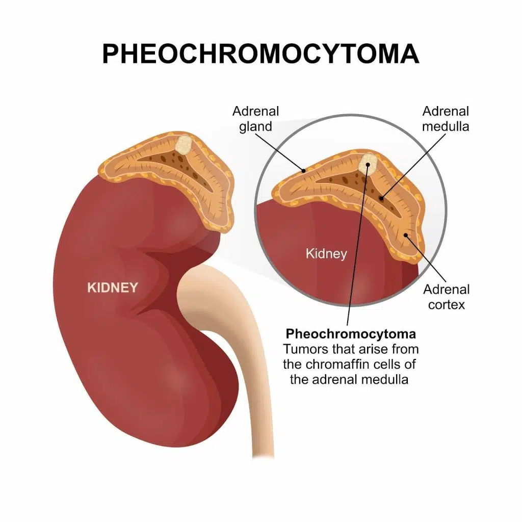 Pheochromocytoma