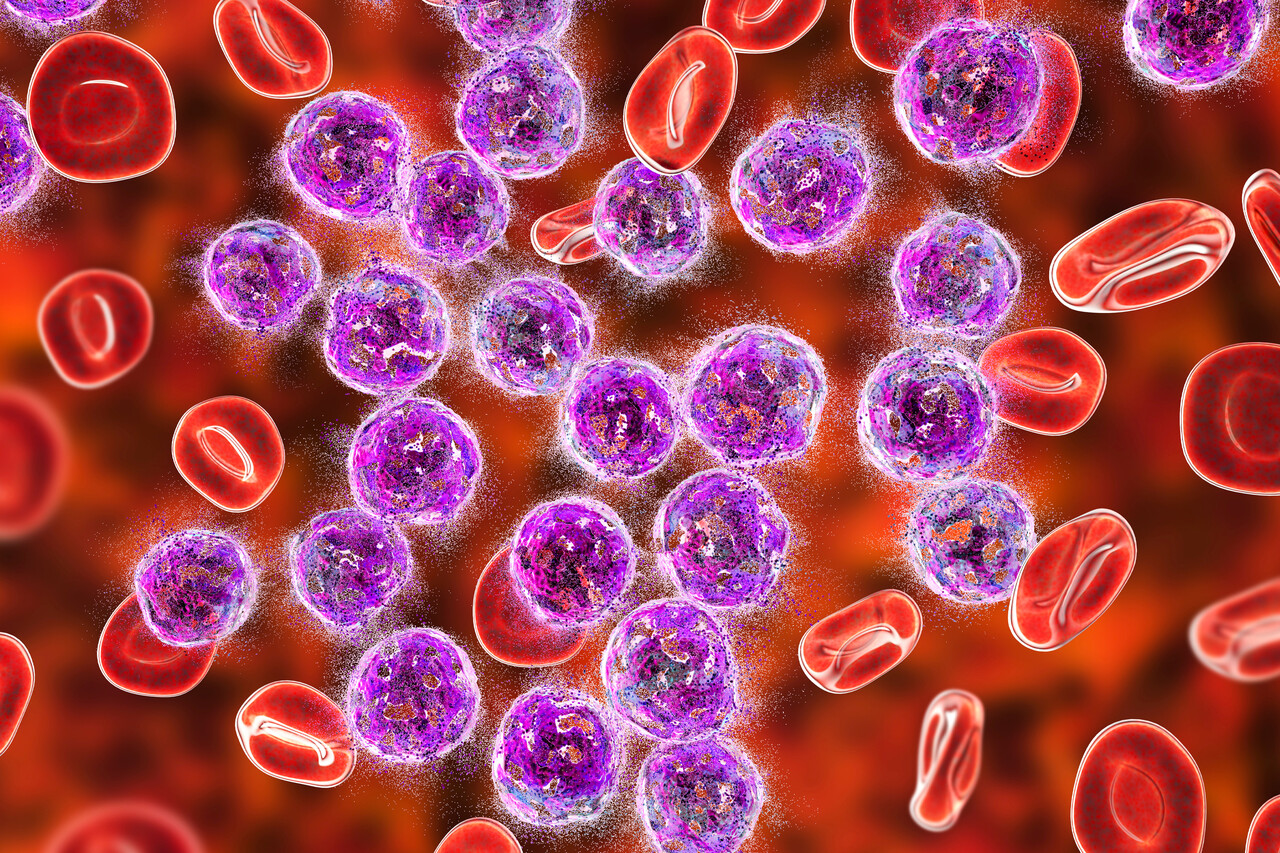 Acute Lymphoblastic Leukemia