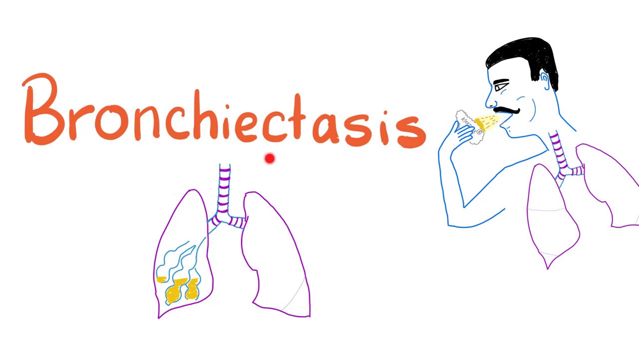 Bronchiectasis