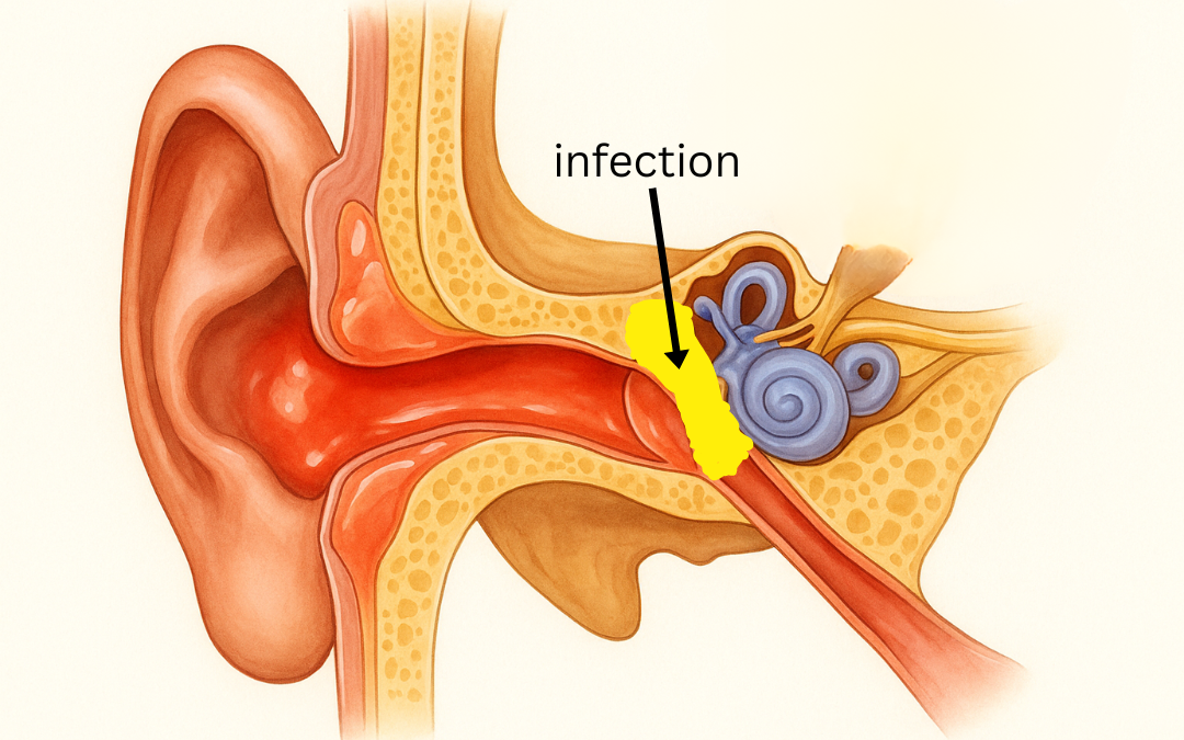 Otitis Media
