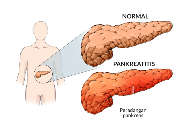 Radang Pankreas: Panduan Lengkap Mengenal Penyebab dan Gejalanya