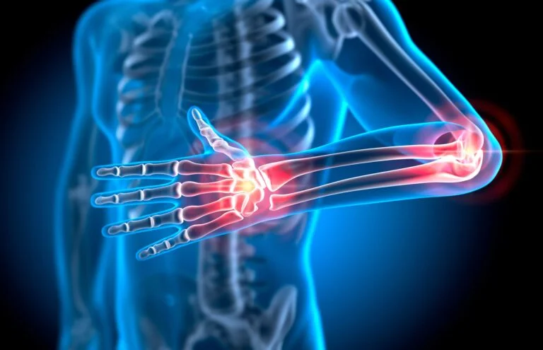 arthritis rheumatoid