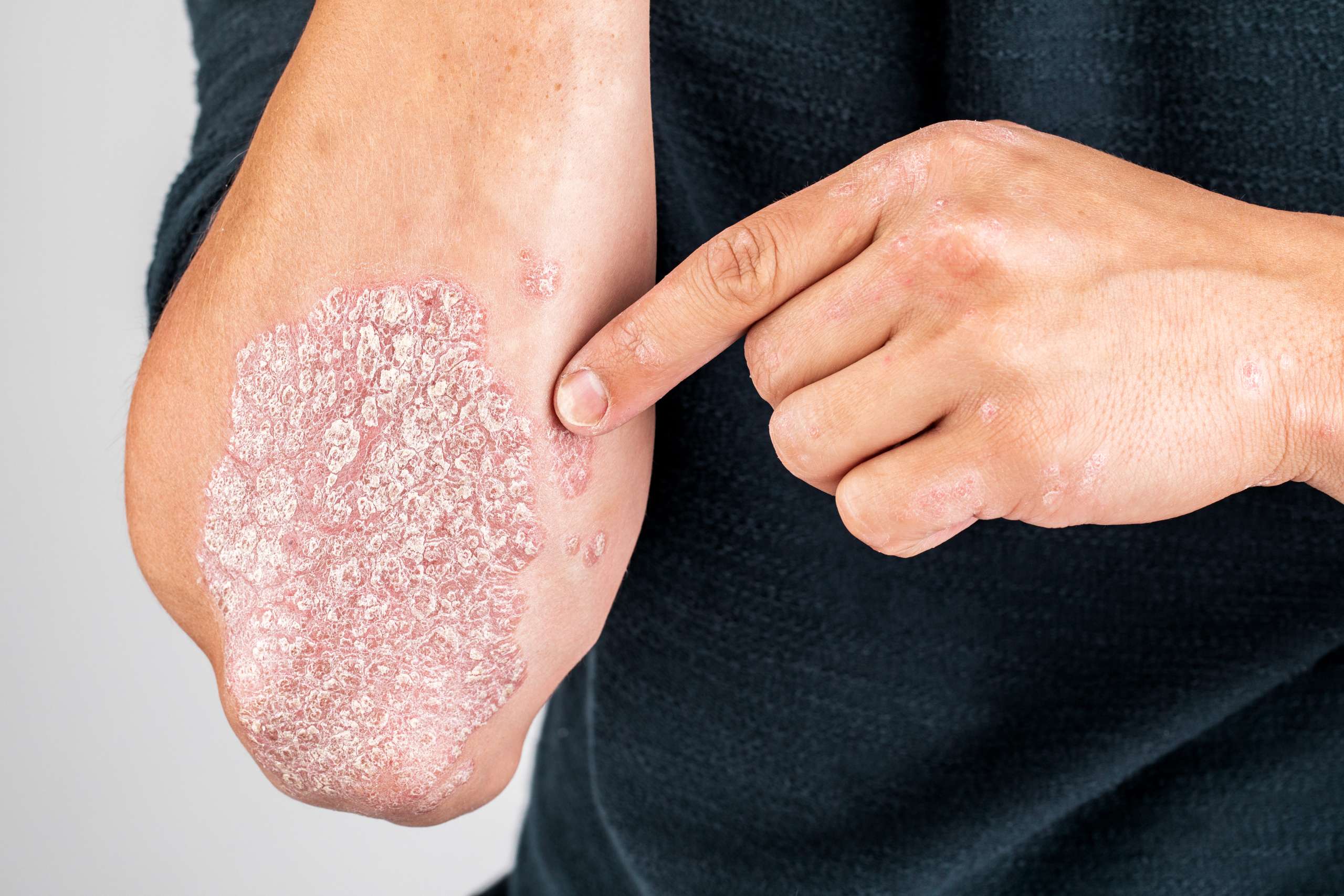 Penyakit Kulit Psoriasis: Pengobatan Topikal hingga Obat Sistemik