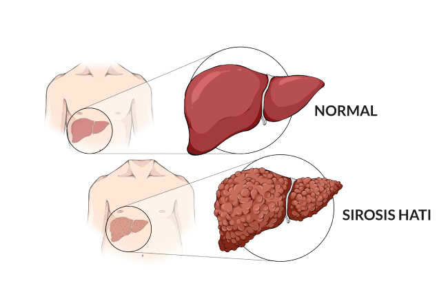 Sirosis Hati