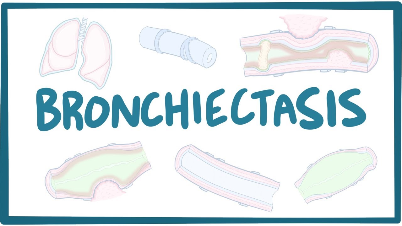 Bronchiectasis