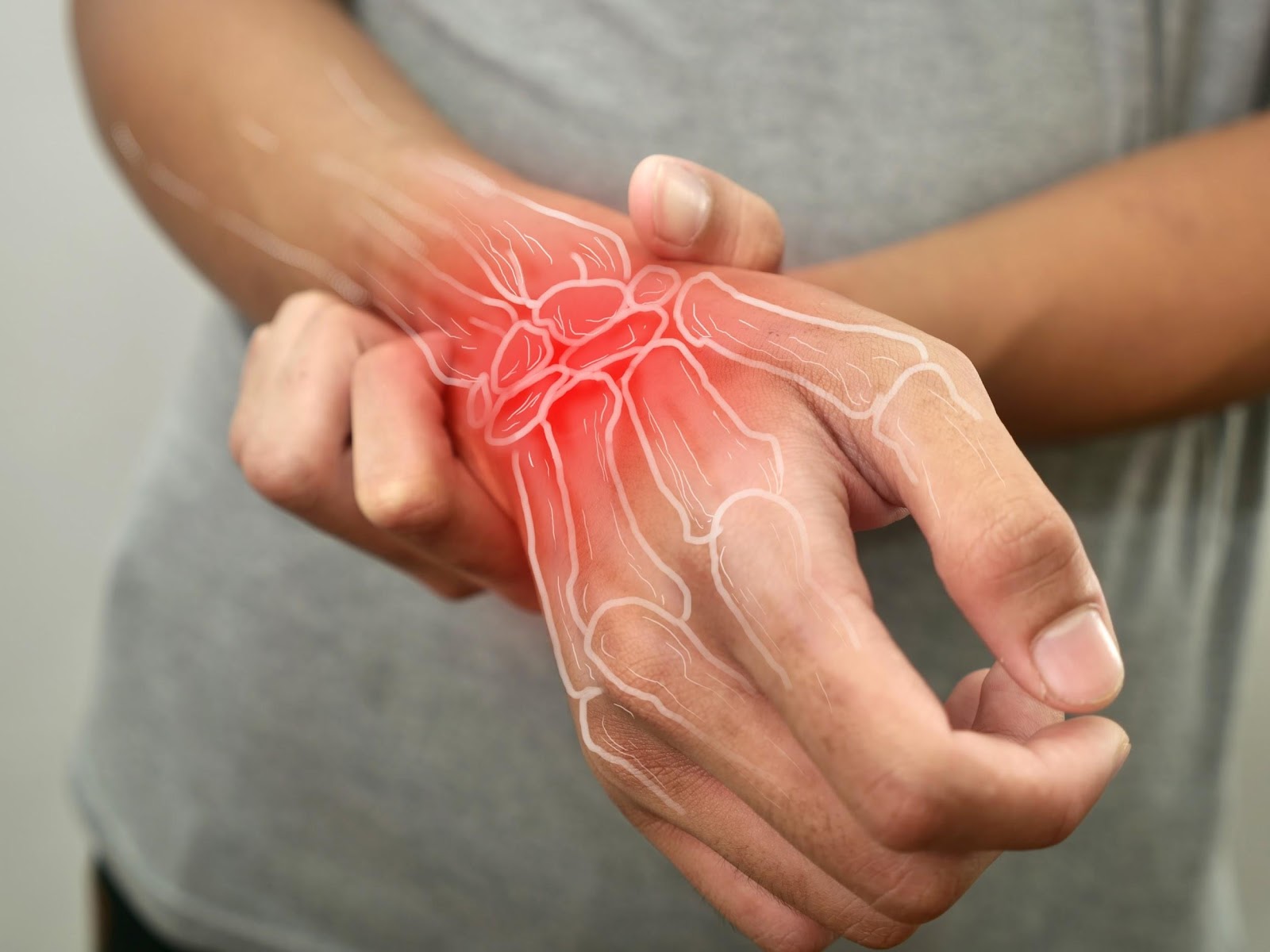 arthritis rheumatoid
