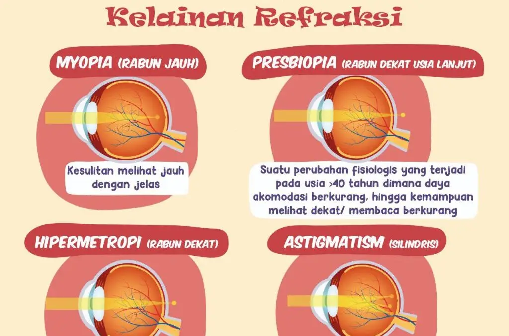 Miopia Mata: Gejala dan Dampaknya pada Kehidupan Sehari-hari