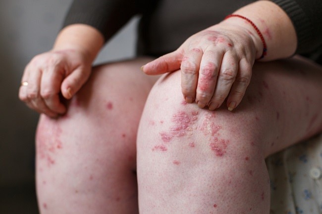 Psoriasis Kulit: Cara Medis dan Alami untuk Mengurangi Gatal dan Bersisik