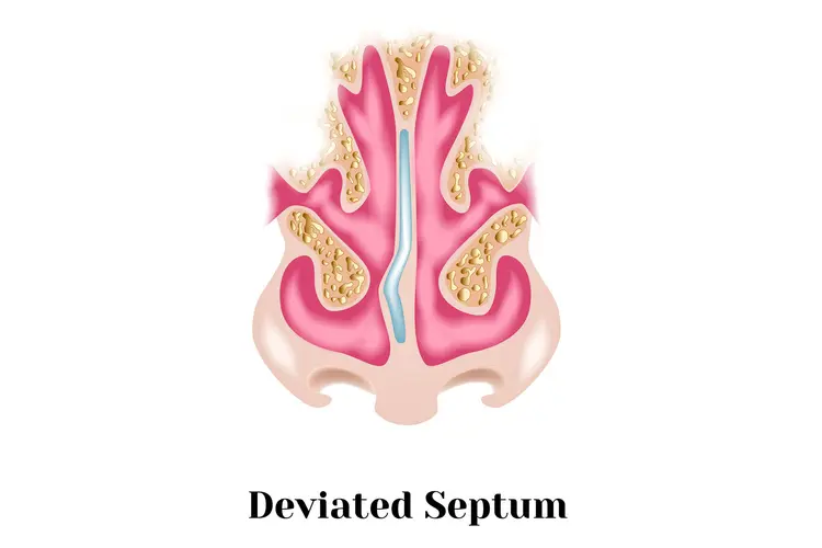 Deviasi Septum