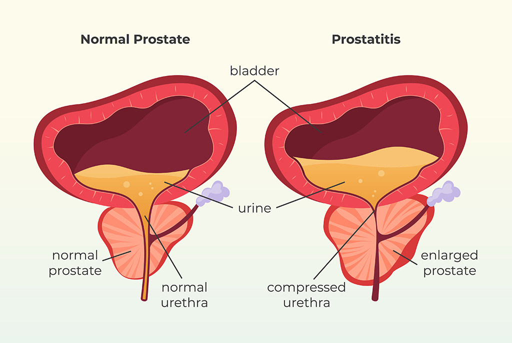 Prostatitis Kronis