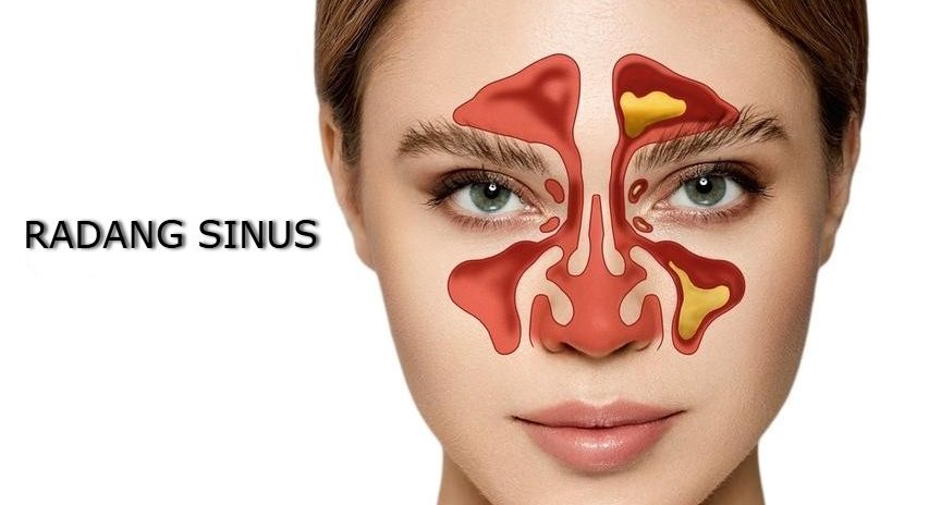 Radang Sinus