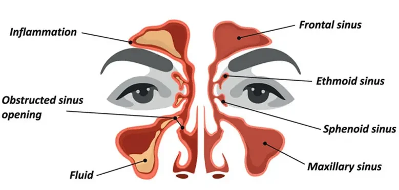Radang Sinus