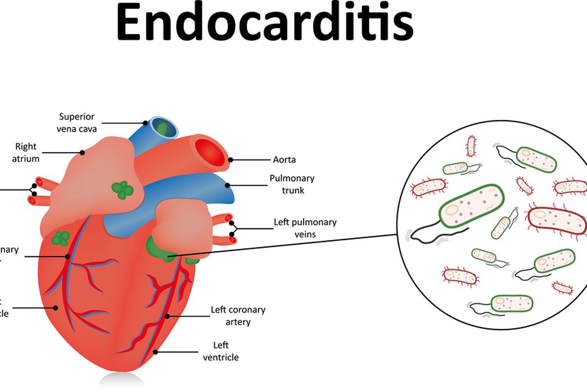 Endokarditis