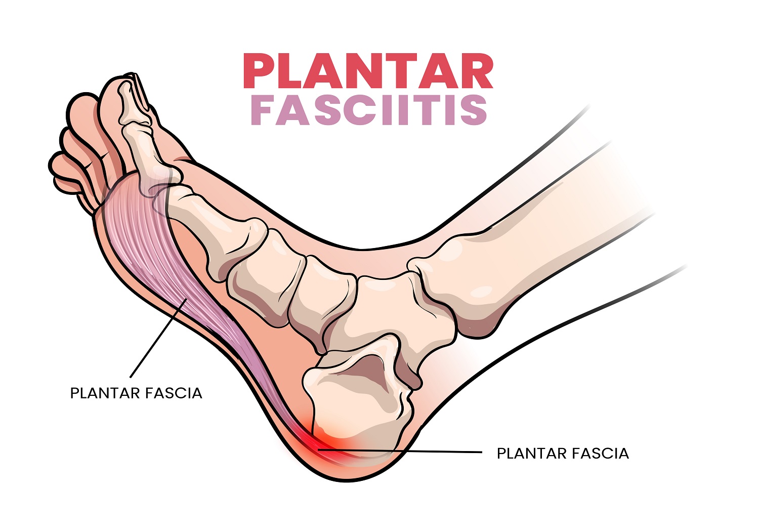 Plantar Fasciitis