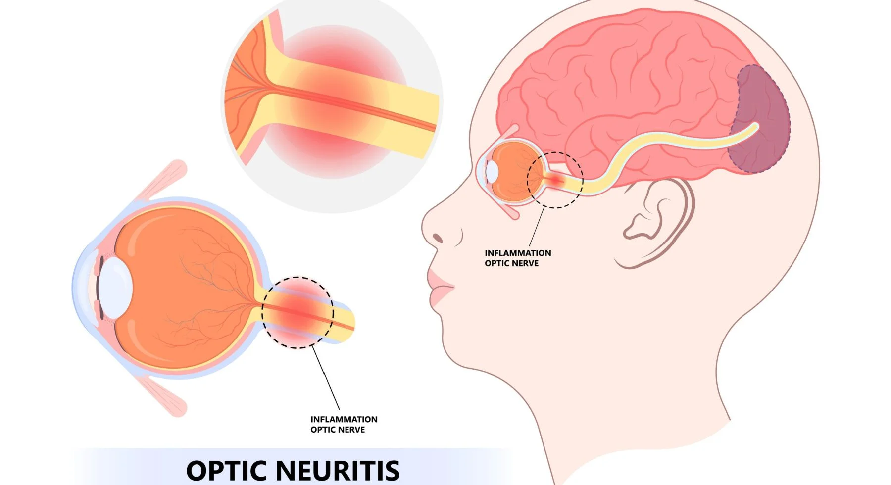 Neuritis Optik