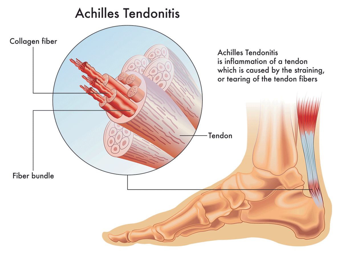 Achilles Tendinopathy