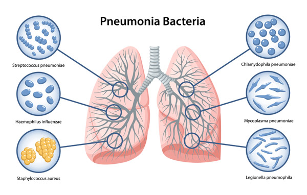 Pneumonia Paru