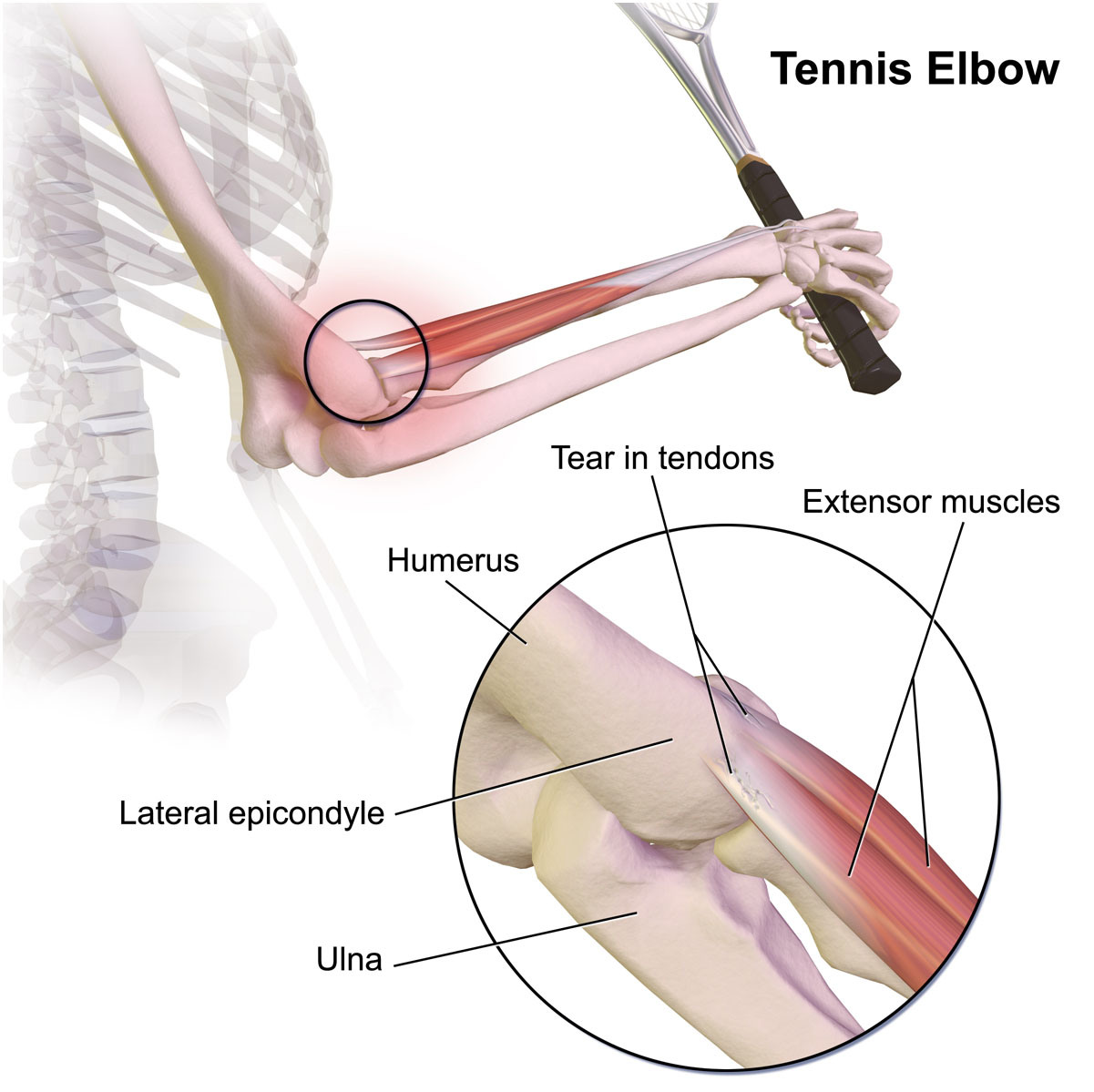 Tennis Elbow