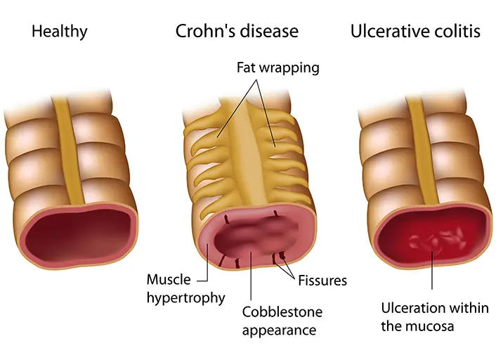 Crohn Usus