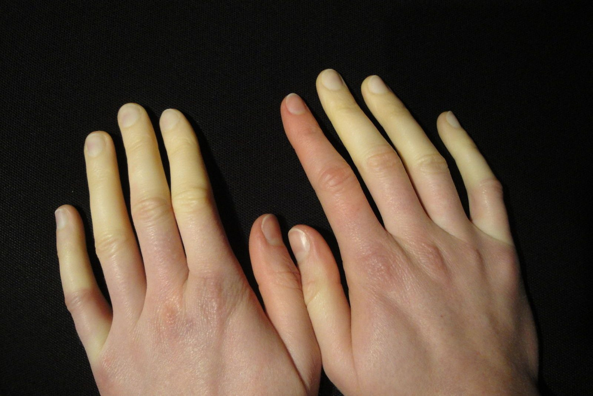 Penyakit Raynaud