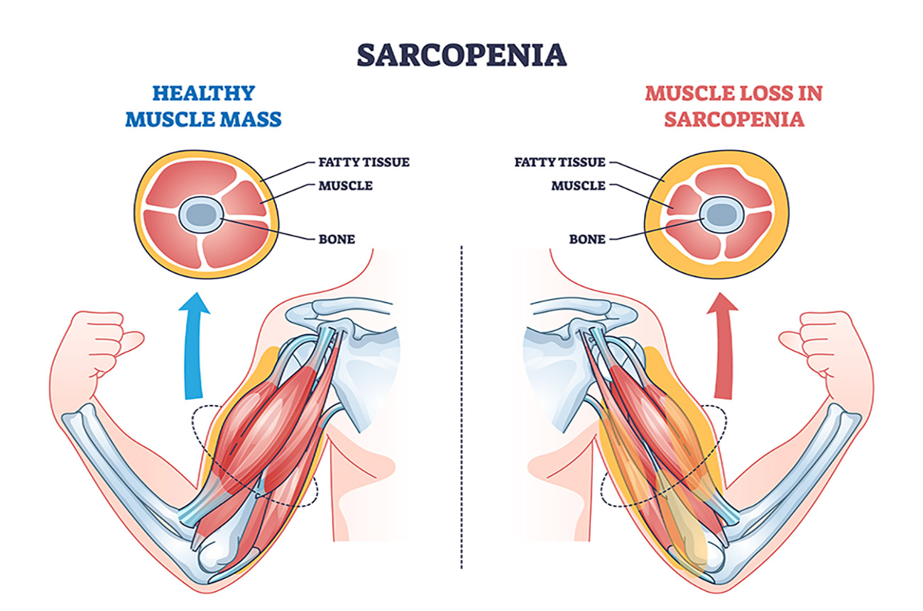 Sarcopenia