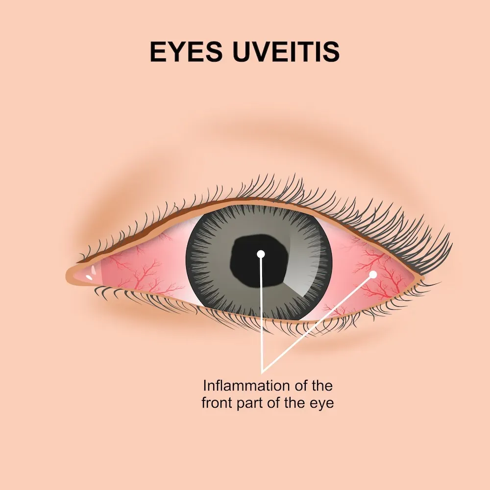 Uveitis