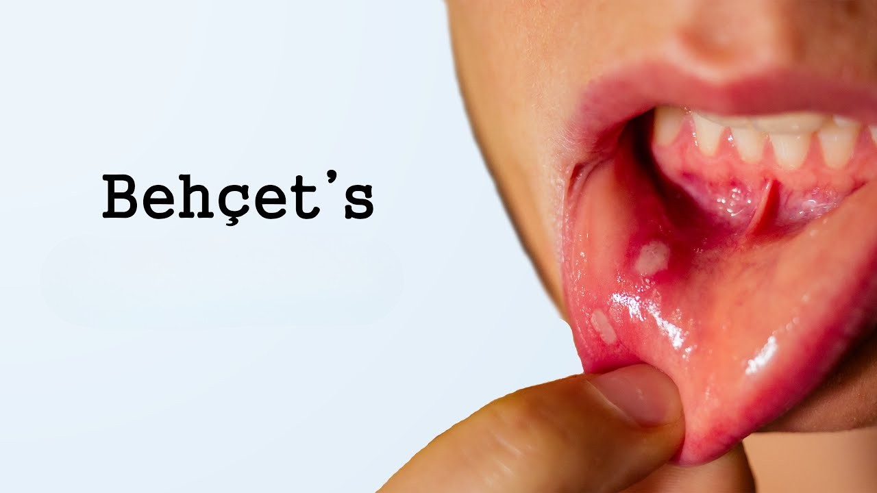 Penyakit Behcet