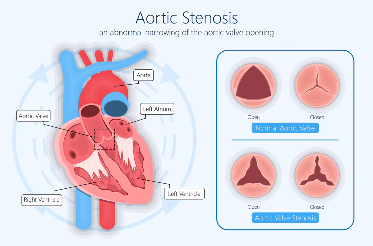 Stenosis Aorta