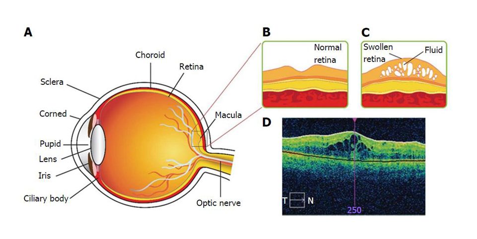 Edema Retina