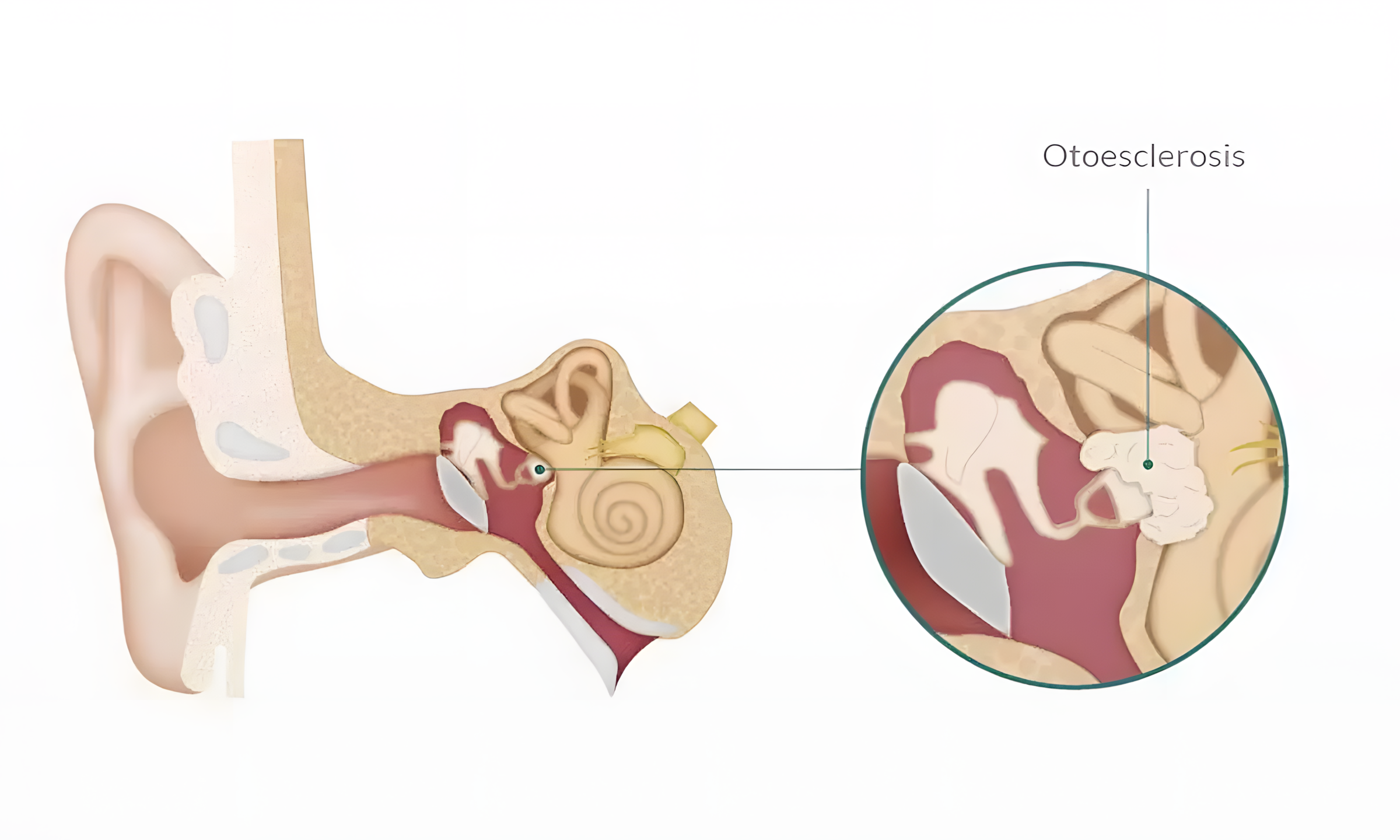Otosklerosis