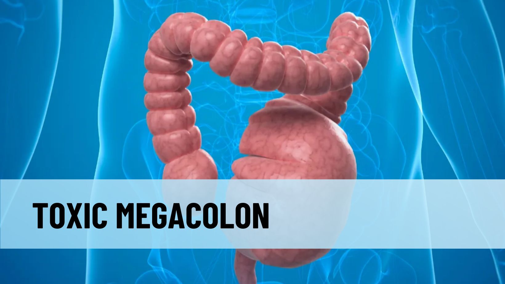 Megakolon Toksik