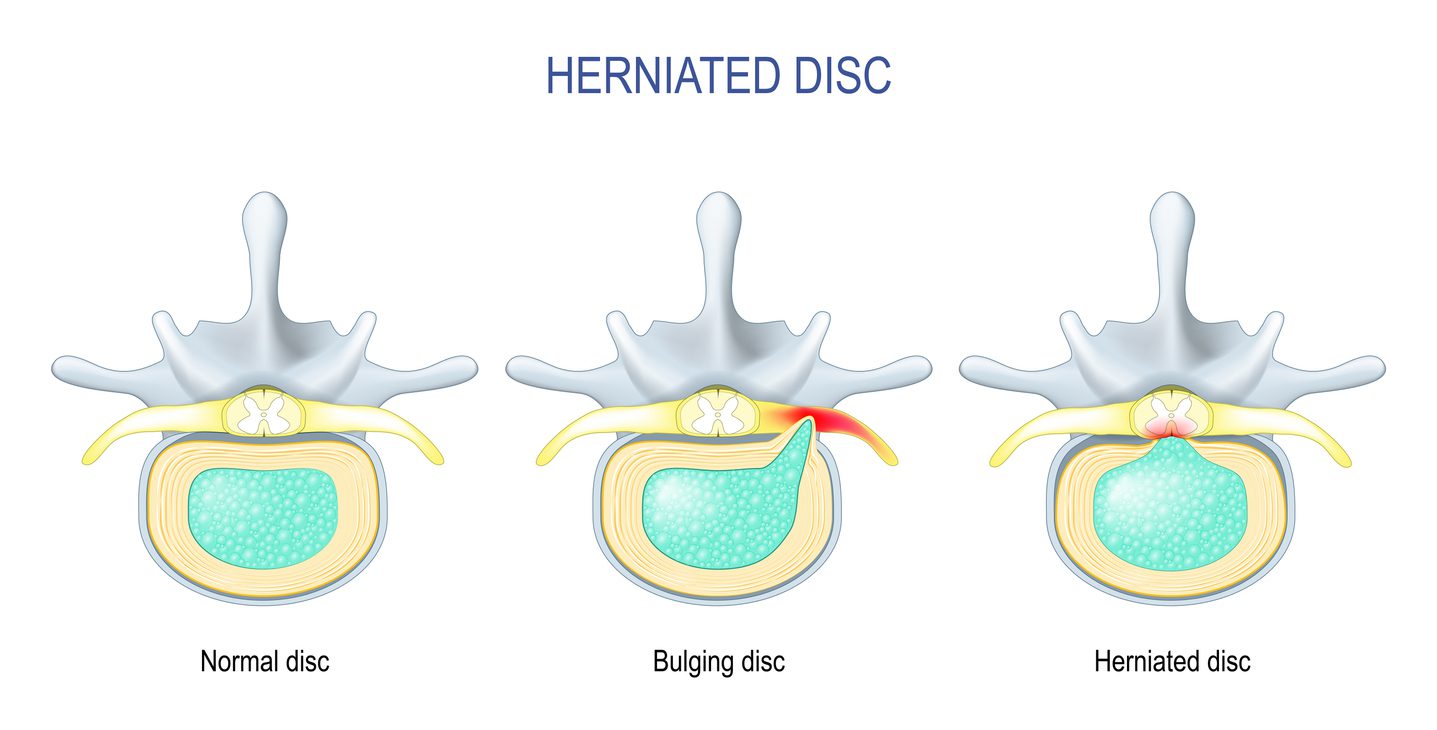 Hernia Diskus