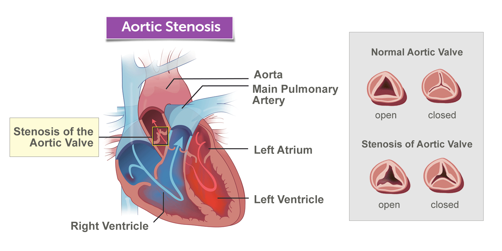 Stenosis Aorta