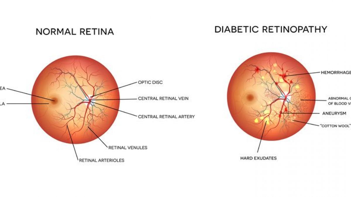 Retinopati Diabetes