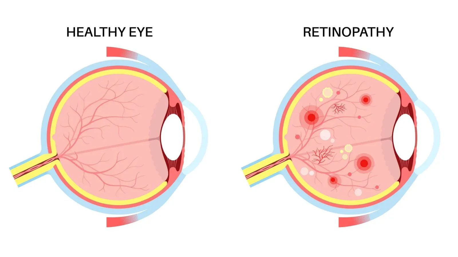 Retinopati Diabetes