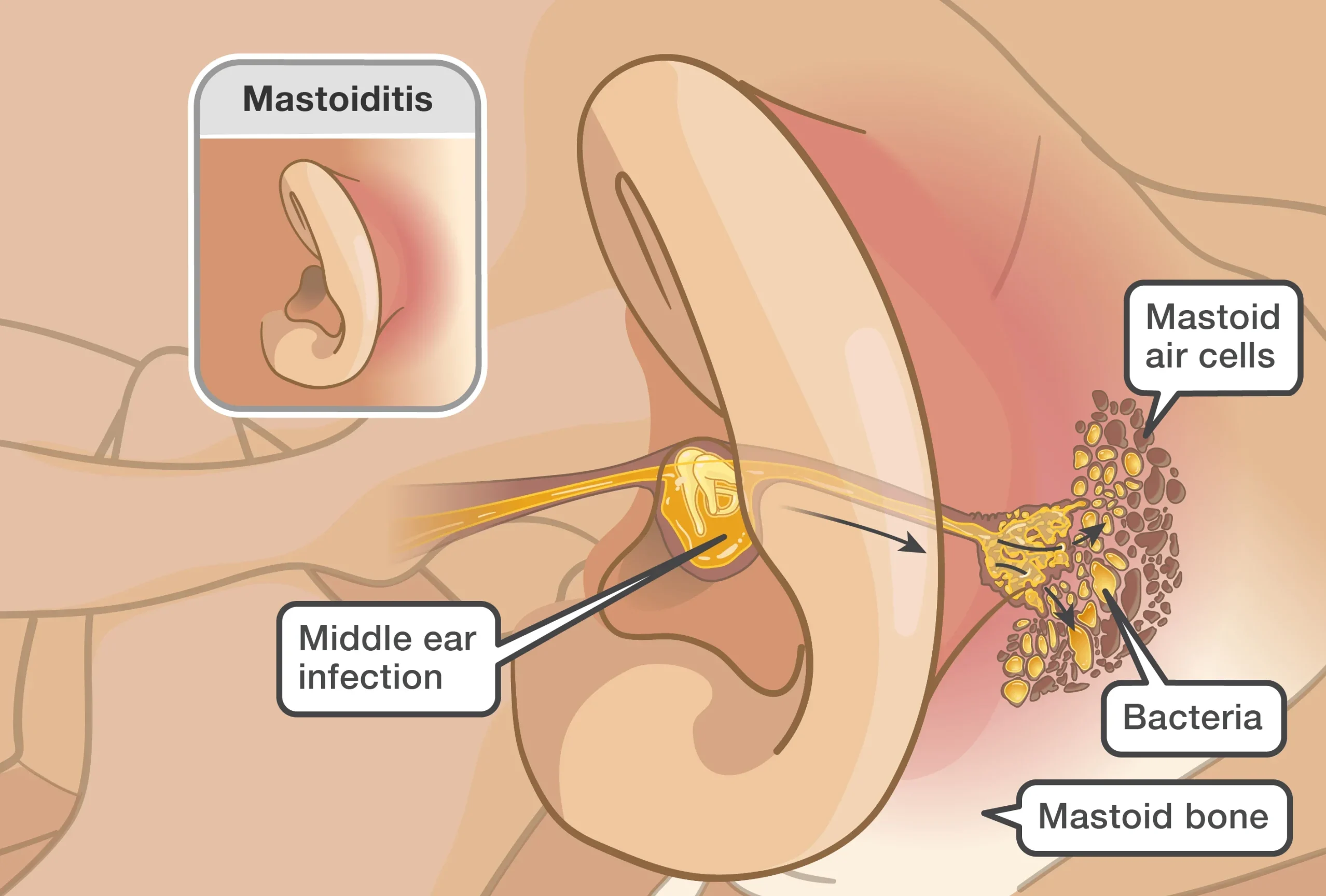Mastoiditis