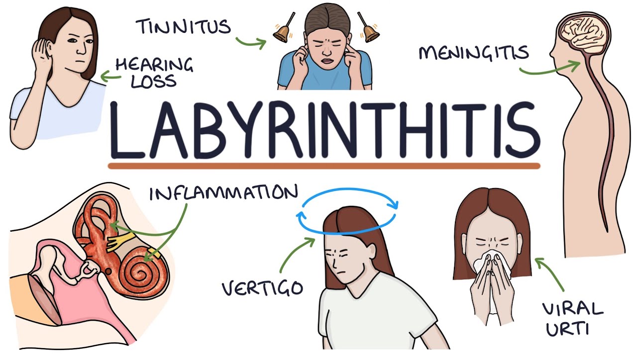 Labirintitis