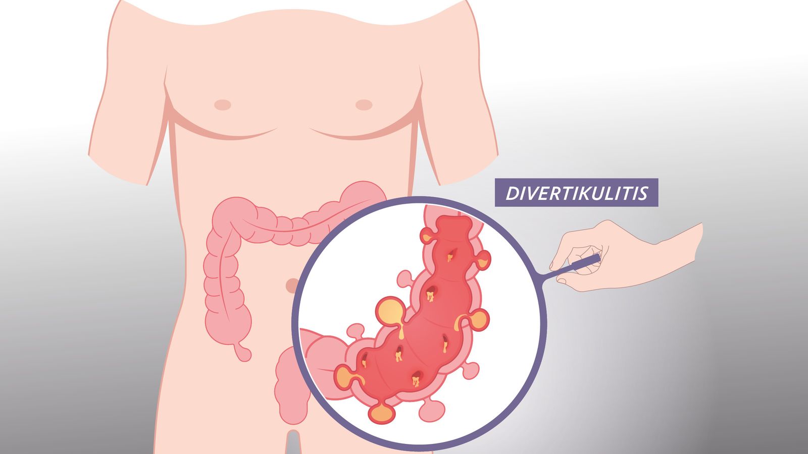 Divertikulitis