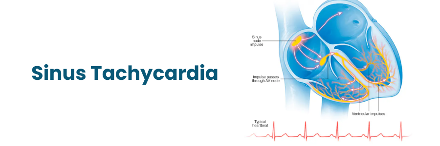 Sinus Takikardia